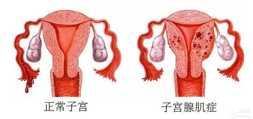 腺肌癥對懷孕的影響，你不會還不知道吧?